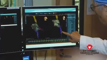 Arrhythmia In Children Is Treated Using 3D Mapping at Joe DiMaggio Childrens Hospital