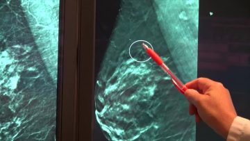 Breast Cancer Survivor Says 3D Mammography Helped Save Her Life