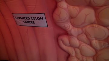 Síntomas de cáncer de colon Othon Wiltz, MD – Memorial Cancer Institute-1
