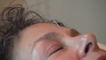 Acupuncture BROLL