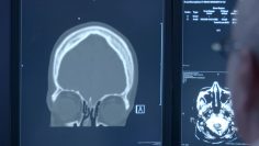 Brain Low-Dose CT Scan