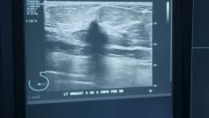 Breast Ultrasound