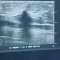 What to expect during a breast ultrasound at Memorial Healthcare System