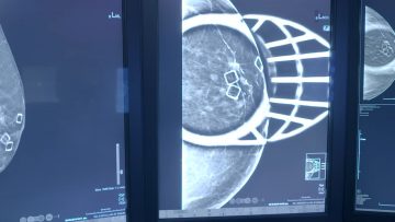 3D Screening or Diagnostic Ammorgram